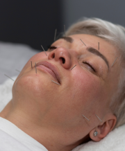 Acupuncture esthétique du visage, technique anti-âge naturelle avec aiguilles très fines.