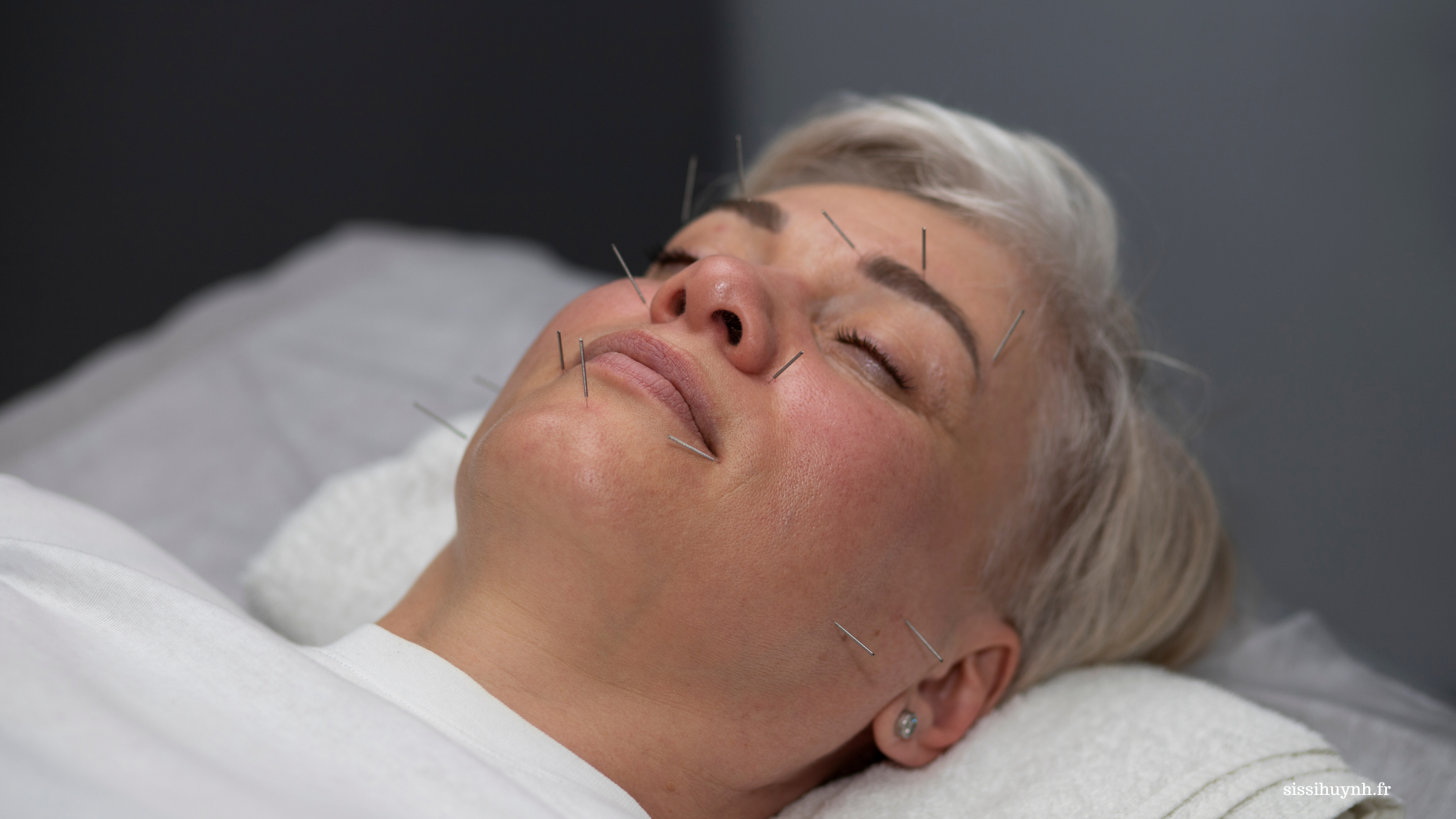 Acupuncture esthétique du visage, technique anti-âge naturelle avec aiguilles très fines.